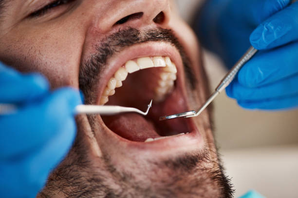 Best Emergency Wisdom Teeth Removal in Palermo, CA
